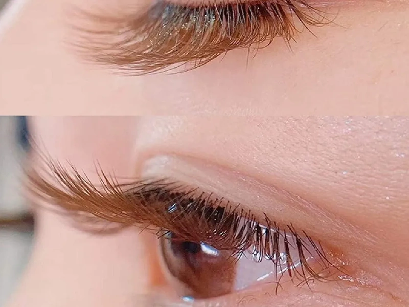 Best Eyelash Transplantation Centers in Mashhad 3 1