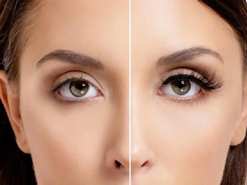 Best Eyelash Transplantation Centers in Mashhad 5 1