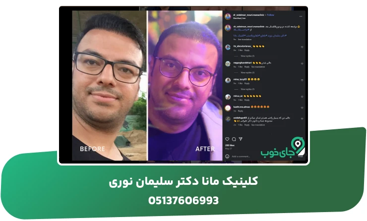 نمونه جراحی پلک آقایان در کلینیک مانا