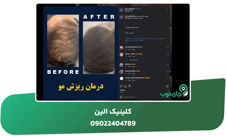 کاشت مو آقایان در کلینیک زیبایی الین مشهد