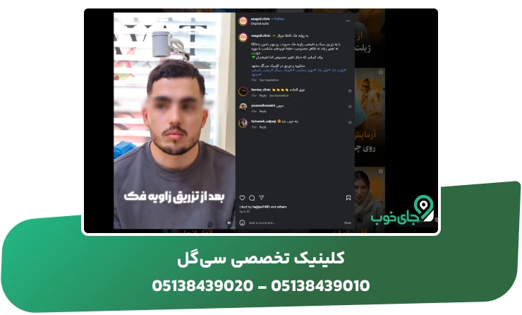 تزریق زاویه فک آقایان در کلینیک سی گل مشهد